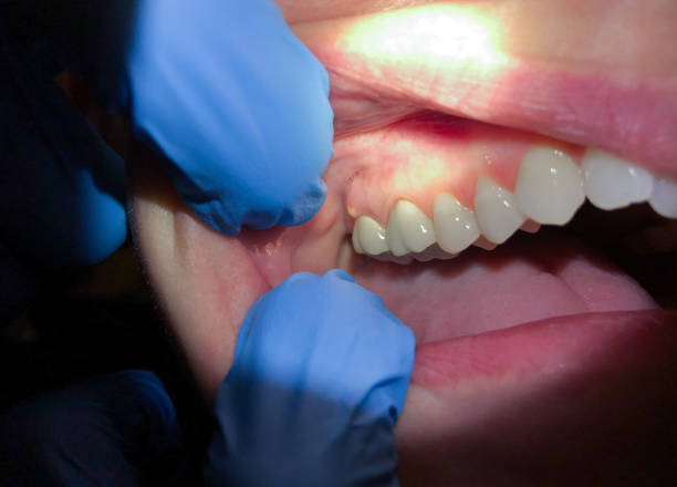 Best Emergency Tooth Extraction in Crossett, AR
